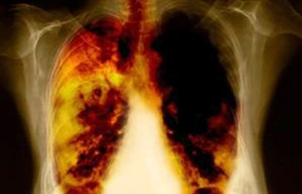 Cáncer de pulmón: Una enfermedad que se puede prevenir, tratar y vencer