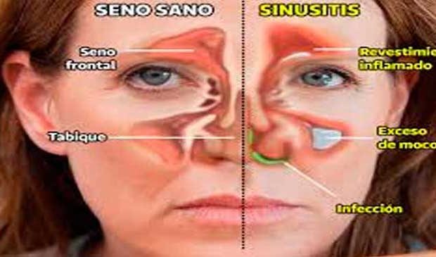 LA SINUSITIS ¿QUÉ ES Y CÓMO ENFRENTARLA?