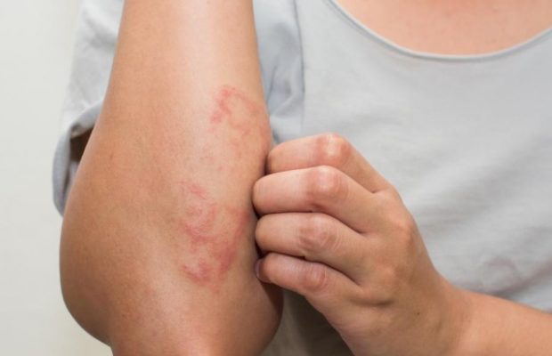La psoriasis afecta la calidad de vida de quienes la padecen